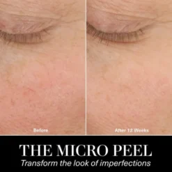 The Micro Peel Facial Peeling